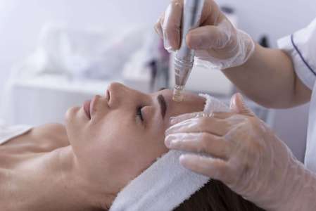 MICRONEEDLING